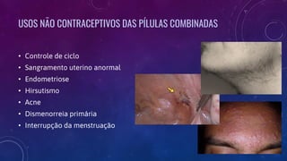 USOS NÃO CONTRACEPTIVOS DAS PÍLULAS COMBINADAS
• Controle de ciclo
• Sangramento uterino anormal
• Endometriose
• Hirsutismo
• Acne
• Dismenorreia primária
• Interrupção da menstruação
 
