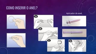 COMO INSERIR O ANEL?
Aplicador do anel
 