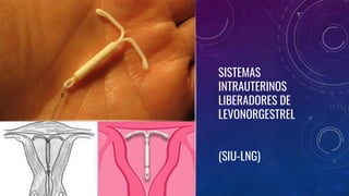 SISTEMAS
INTRAUTERINOS
LIBERADORES DE
LEVONORGESTREL
(SIU-LNG)
 