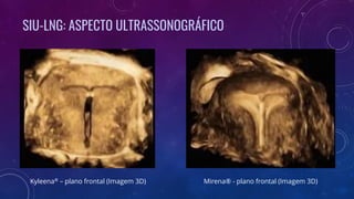 SIU-LNG: ASPECTO ULTRASSONOGRÁFICO
Kyleena® – plano frontal (Imagem 3D) Mirena® - plano frontal (Imagem 3D)
 