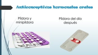 Anticonceptivos hormonales orales
Píldora y
minipíldora
Píldora del día
después
 