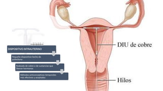 DISPOSITIVO INTRAUTERINO
Pequeño dispositivo hecho de
polietileno
Rodeado de cobre o de sustancias que
liberan hormonas
Métodos anticonceptivos temporales
más efectivos y aceptados
 