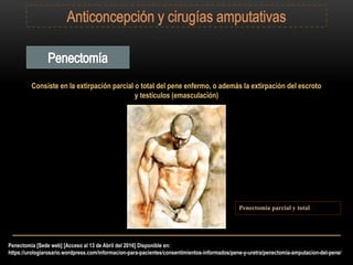 Penectomía [Sede web] [Acceso al 13 de Abril del 2016] Disponible en:
https://urologiarosario.wordpress.com/informacion-para-pacientes/consentimientos-informados/pene-y-uretra/penectomia-amputacion-del-pene/
Consiste en la extirpación parcial o total del pene enfermo, o además la extirpación del escroto
y testículos (emasculación)
Penectomia parcial y total
 