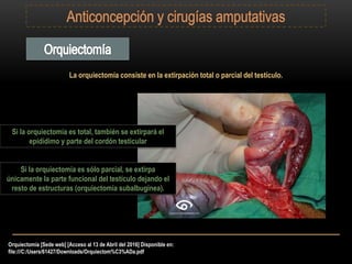 Orquiectomía [Sede web] [Acceso al 13 de Abril del 2016] Disponible en:
file:///C:/Users/61427/Downloads/Orquiectom%C3%ADa.pdf
La orquiectomía consiste en la extirpación total o parcial del testículo.
Si la orquiectomía es total, también se extirpará el
epidídimo y parte del cordón testicular
Si la orquiectomía es sólo parcial, se extirpa
únicamente la parte funcional del testículo dejando el
resto de estructuras (orquiectomía subalbuginea).
 