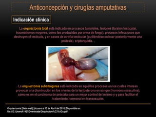 Orquiectomía [Sede web] [Acceso al 13 de Abril del 2016] Disponible en:
file:///C:/Users/61427/Downloads/Orquiectom%C3%ADa.pdf
La orquiectomía total está indicada en procesos tumorales, lesiones (torsión testicular,
traumatismos mayores, como las producidas por arma de fuego), procesos infecciosos que
destruyen el testículo, y en casos de atrofia testicular (pudiéndose colocar posteriormente una
prótesis), criptorquidia. .
Indicación clínica
La orquiectomía subalbuginea está indicada en aquellos procesos en los cuales interesa
provocar una disminución en los niveles de la testosterona en sangre (hormona masculina),
como es en el carcinoma de próstata para un mejor control del mismo y y para facilitar el
tratamiento hormonal en transexuales
 