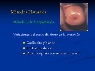 Métodos Naturales
 Cuello alto y blando.
 OCE entreabierto.
 Dificil, requiere entrenamiento previo
Método de la Autopalpación
Variaciones del cuello del útero en la ovulación
 