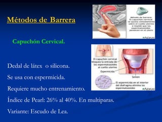 Métodos de Barrera
Capuchón Cervical.
Dedal de látex o silicona.
Se usa con espermicida.
Requiere mucho entrenamiento.
Índice de Pearl: 26% al 40%. En multiparas.
Variante: Escudo de Lea.
 