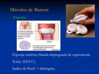 Métodos de Barrera
Esponja.
Esponja sintética blanda impregnada de espermicida
Today (EEUU).
Índice de Pearl: > diafragma.
 