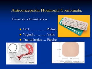 Anticoncepción Hormonal Combinada.
 Oral ………….. Píldora
 Vaginal ………. Anillo
 Transdérmica … Parche
Forma de administración.
 