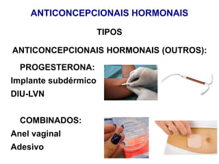 ANTICONCEPCIONAIS HORMONAIS (OUTROS):
TIPOS
PROGESTERONA:
Implante subdérmico
DIU-LVN
COMBINADOS:
Anel vaginal
Adesivo
ANTICONCEPCIONAIS HORMONAIS
 