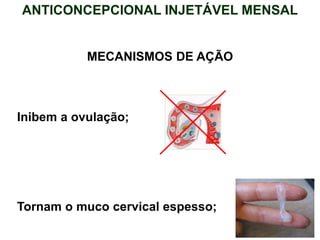 Inibem a ovulação;
Tornam o muco cervical espesso;
MECANISMOS DE AÇÃO
ANTICONCEPCIONAL INJETÁVEL MENSAL
 