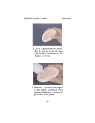 FEBRASGO - Manual de Orientação Anticoncepção
212
b. Coloca-se aproximadamente uma co-
lher de sopa de geléia ou creme
espermicida na face côncava do dia-
fragma e nas bordas;
c. Mantendo a face convexa voltada para
a palma da mão, aproxima as bordas
opostas do diafragma e o coloca na va-
gina, o mais fundo possível;
 