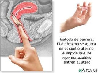 Métodos mecánicos o de barrera. Preservativo femenino o masculino. Diafragma. Dispositivos intrauterino (D.I.U.). 