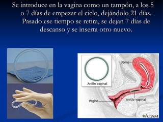 Se introduce en la vagina como un tampón, a los 5 o 7 días de empezar el ciclo, dejándolo 21 días. Pasado ese tiempo se retira, se dejan 7 días de descanso y se inserta otro nuevo. 