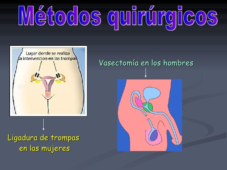 Resultado de imagen para metodos quirurgicos vasectomia Y LIGADURA DETROMPAS DE FALOPIO
