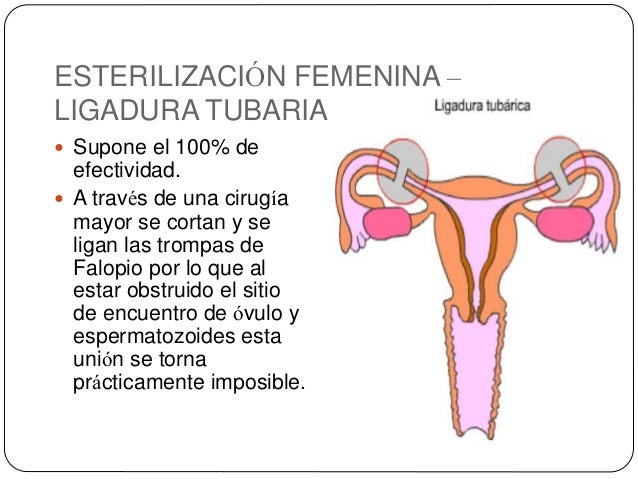 Anticonceptivos