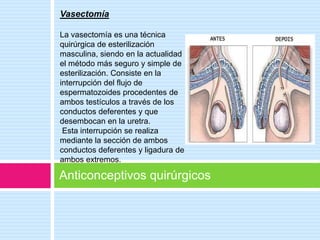 Vasectomía

La vasectomía es una técnica
quirúrgica de esterilización
masculina, siendo en la actualidad
el método más seguro y simple de
esterilización. Consiste en la
interrupción del flujo de
espermatozoides procedentes de
ambos testículos a través de los
conductos deferentes y que
desembocan en la uretra.
 Esta interrupción se realiza
mediante la sección de ambos
conductos deferentes y ligadura de
ambos extremos.

Anticonceptivos quirúrgicos
 