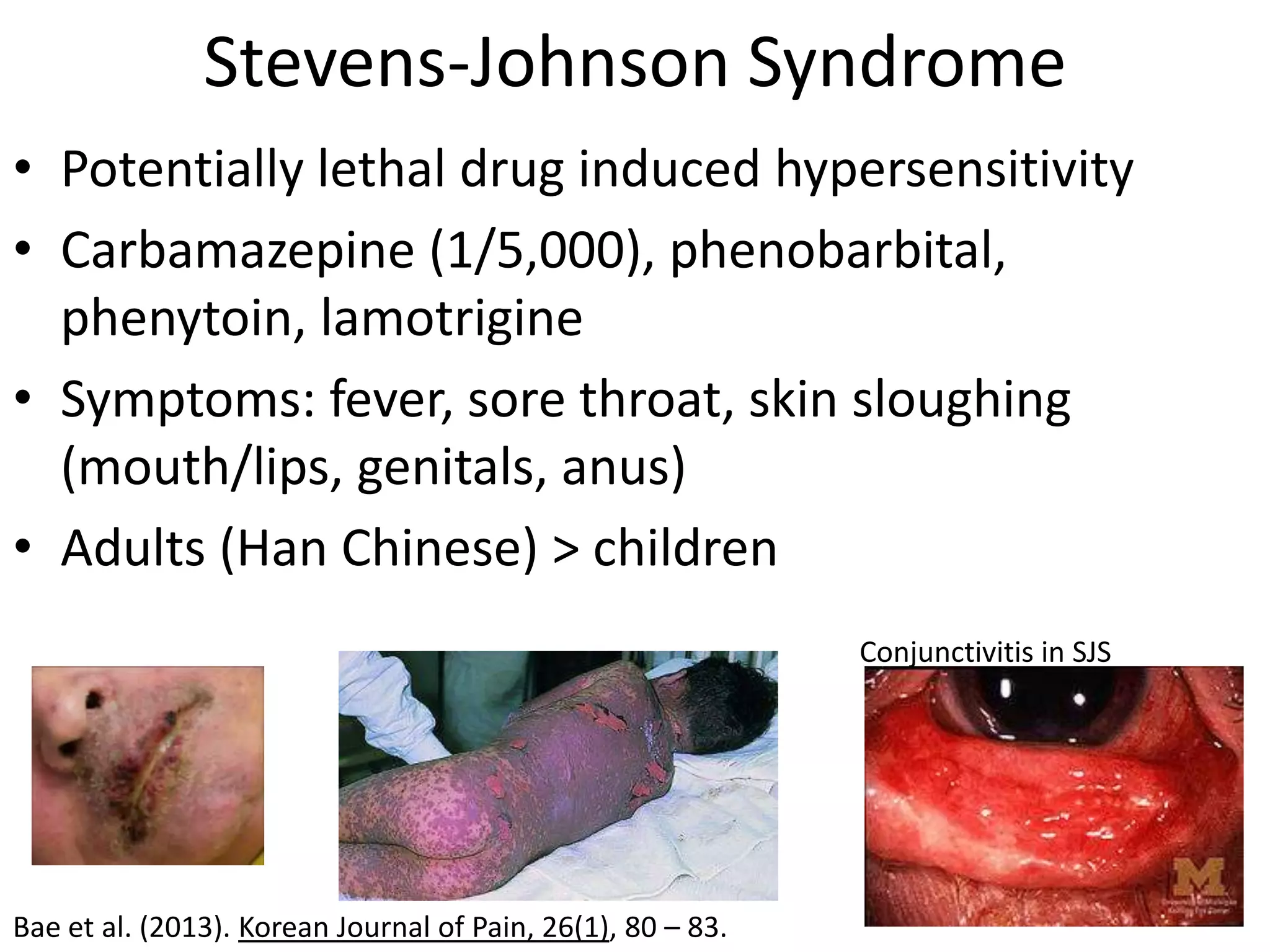 Stevens-Johnson Syndrome
• Potentially lethal drug induced hypersensitivity
• Carbamazepine (1/5,000), phenobarbital,
  phenytoin, lamotrigine
• Symptoms: fever, sore throat, skin sloughing
  (mouth/lips, genitals, anus)
• Adults (Han Chinese) > children
                                                             Conjunctivitis in SJS




Bae et al. (2013). Korean Journal of Pain, 26(1), 80 – 83.
 