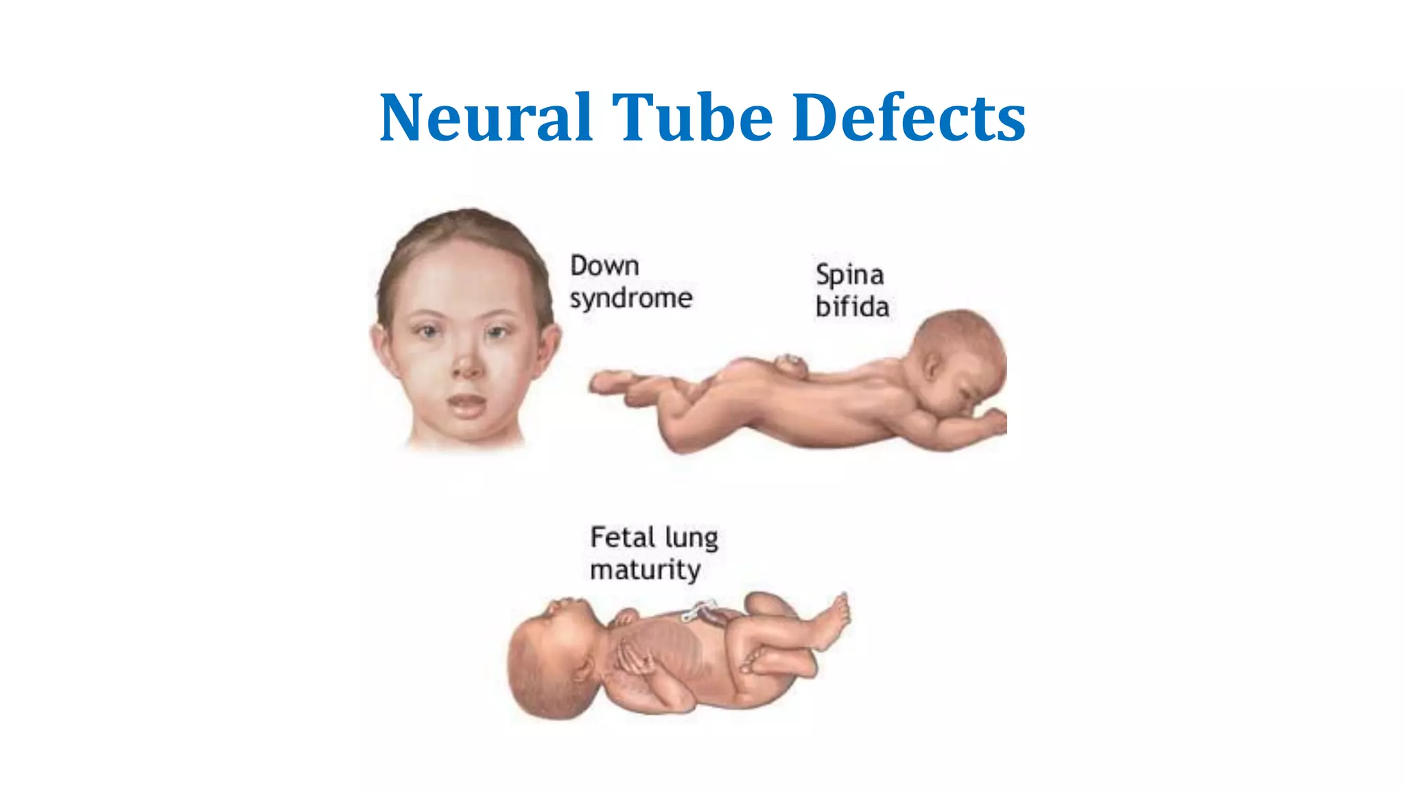 Neural Tube Defects
 