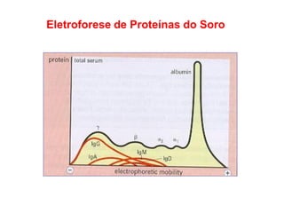 Eletroforese de Proteínas do Soro
 