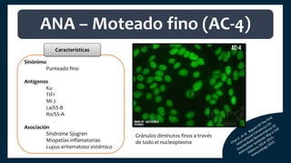 Sinónimo
Punteado fino
Antígenos
Ku
TIF1
Mi-2
La/SS-B
Ro/SS-A
Asociación
Síndrome Sjogren
Miopatías inflamatorias
Lupus eritematoso sistémico
ANA – Moteado fino (AC-4)
Características
Gránulos diminutos finos a través
de todo el nucleoplasma
 