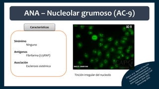 Sinónimo
Ninguno
Antígenos
Fibrilarina (U3RNP)
Asociación
Esclerosis sistémica
ANA – Nucleolar grumoso (AC-9)
Características
Tinción irregular del nucleolo
 