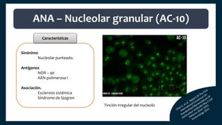Sinónimo
Nucleolar punteado.
Antígenos
NOR – 90
ARN polimerasa I
Asociación.
Esclerosis sistémica
Síndrome de Sjogren
ANA – Nucleolar granular (AC-10)
Características
Tinción irregular del nucleolo
 