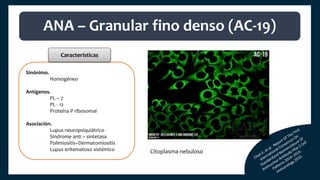 Sinónimo.
Homogéneo
Antígenos.
PL – 7
PL - 12
Proteína P ribosomal
Asociación.
Lupus neuropsiquiátrico
Síndrome anti – sintetasa
Polimiositis–Dermatomiositis
Lupus eritematoso sistémico
ANA – Granular fino denso (AC-19)
Características
Citoplasma nebuloso
 