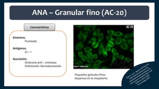 Sinónimo.
Punteado
Antígenos.
Jo – 1
Asociación.
Síndrome anti – sintetasa
Polimiositis–Dermatomiositis
ANA – Granular fino (AC-20)
Características
Pequeños gránulos finos
dispersos en el citoplasma
 