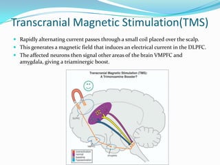 Transcranial Magnetic Stimulation(TMS)
 Rapidly alternating current passes through a small coil placed over the scalp.
 This generates a magnetic field that induces an electrical current in the DLPFC.
 The affected neurons then signal other areas of the brain VMPFC and
  amygdala, giving a triaminergic boost.
 