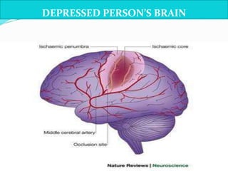 DEPRESSED PERSON’S BRAIN
 