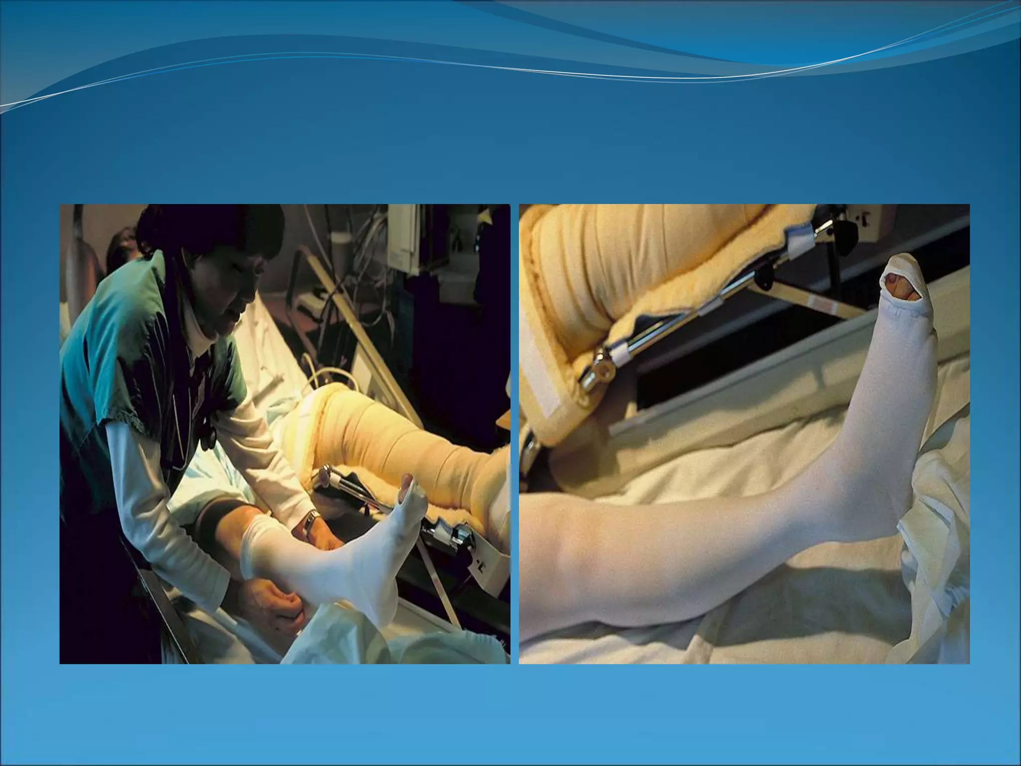 Embolic Trashing ANTI EMBOLIC STOCKING | PPT