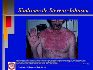 Síndrome de Stevens-Johnson




http://missinglink.ucsf.edu/lm/DermatologyGlossary/img/Dermatology%20Glossary/Glos
sary%20Clinical%20Images/Stevens_Johnson-28.jpg
                                                                            P-Slide 59
  American Epilepsy Society 2008
 