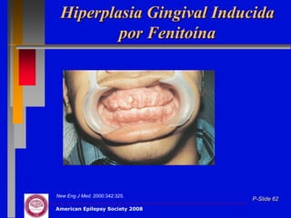 Hiperplasia Gingival Inducida
         por Fenitoína




New Eng J Med. 2000:342:325.
                                 P-Slide 62
American Epilepsy Society 2008
 