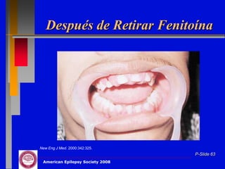 Después de Retirar Fenitoína




New Eng J Med. 2000:342:325.
                                  P-Slide 63
 American Epilepsy Society 2008
 