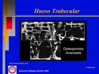 Hueso Trabecular




                                           Osteoporosis
                                            Avanzada

http://www.merck.com

                                                          P-Slide 64
          American Epilepsy Society 2008
 
