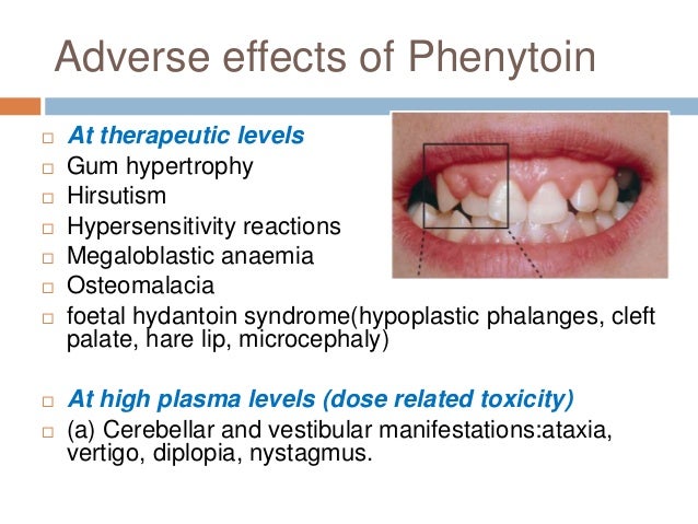 Antiepileptics Antiepileptics