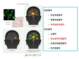 부분발작
• 단순부분발작
• 복합부분발작
• 이차성전신발작
전신발작
• 소발작
• 전신강직간대발작
• 근육간대경련발작
• 무긴장발작
 