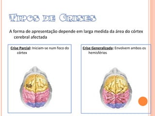 A forma de apresentação depende em larga medida da área do córtex cerebral afectada Crise Parcial :  Iniciam-se num foco do córtex Crise Generalizada :  Envolvem ambos os hemisférios 