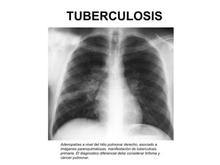 Adenopatías a nivel del hilio pulmonar derecho, asociado a imágenes parenquimatosas, manifestación de tuberculosis primaria. El diagnostico diferencial debe considerar linfoma y cáncer pulmonar.   TUBERCULOSIS 