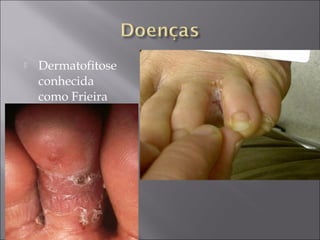    Dermatofitose
    conhecida
    como Frieira
 
