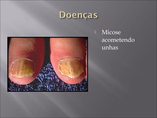    Micose
    acometendo
    unhas
 