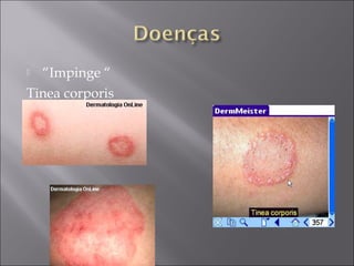  “Impinge “
Tinea corporis
 