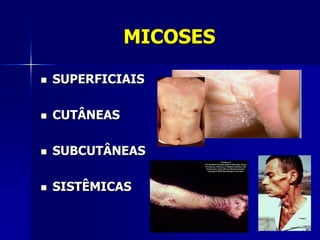 MICOSES

   SUPERFICIAIS

   CUTÂNEAS

   SUBCUTÂNEAS

   SISTÊMICAS
 