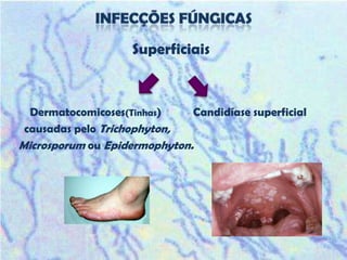 Superficiais



  Dermatocomicoses(Tinhas)    Candidíase superficial
 causadas pelo Trichophyton,
Microsporum ou Epidermophyton.
 