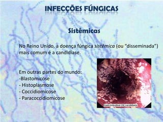 Sistêmicas

No Reino Unido, a doença fúngica sistêmica (ou “disseminada”)
mais comum é a candidíase.


Em outras partes do mundo:
-Blastomicose
- Histoplasmose
- Coccidiomicose
- Paracoccidiomicose
 