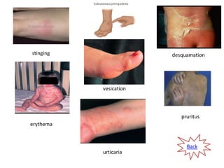 Vesication Antifungal drugs-Synthetic agents | PPTX