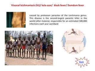 Visceral leishmaniasis (VL)/ kala-azar/ black fever/ Dumdum fever

caused by protozoan parasites of the Leishmania genus.
...