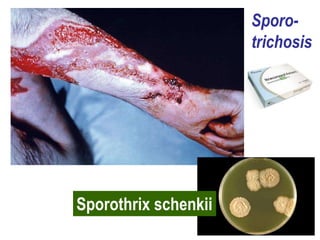 Sporo-
trichosis
Sporothrix schenkii
 