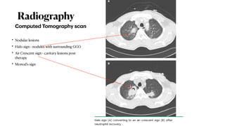 Manod Sign Fungal Infections in the Intensive Care Unit and Antifungals | PDF
